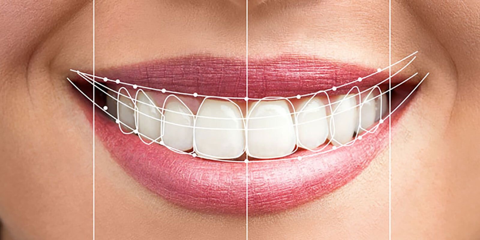 Blanchiment Dentaire